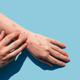 Image for article titled Texas Reports First U.S. Death Linked to Monkeypox